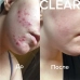 Усиленный ежедневный эксфолиант c 2% ВНА для проблемной кожи 118 мл / Clear extra strenth anti-redness exfoliating solution with 2% BHA 